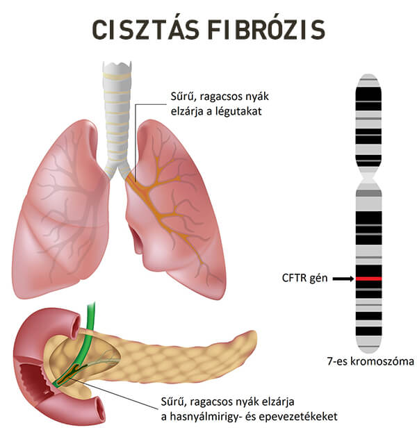 Cisztás fibrózis